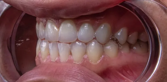 Scaling And Polishing Vs. Teeth Whitening