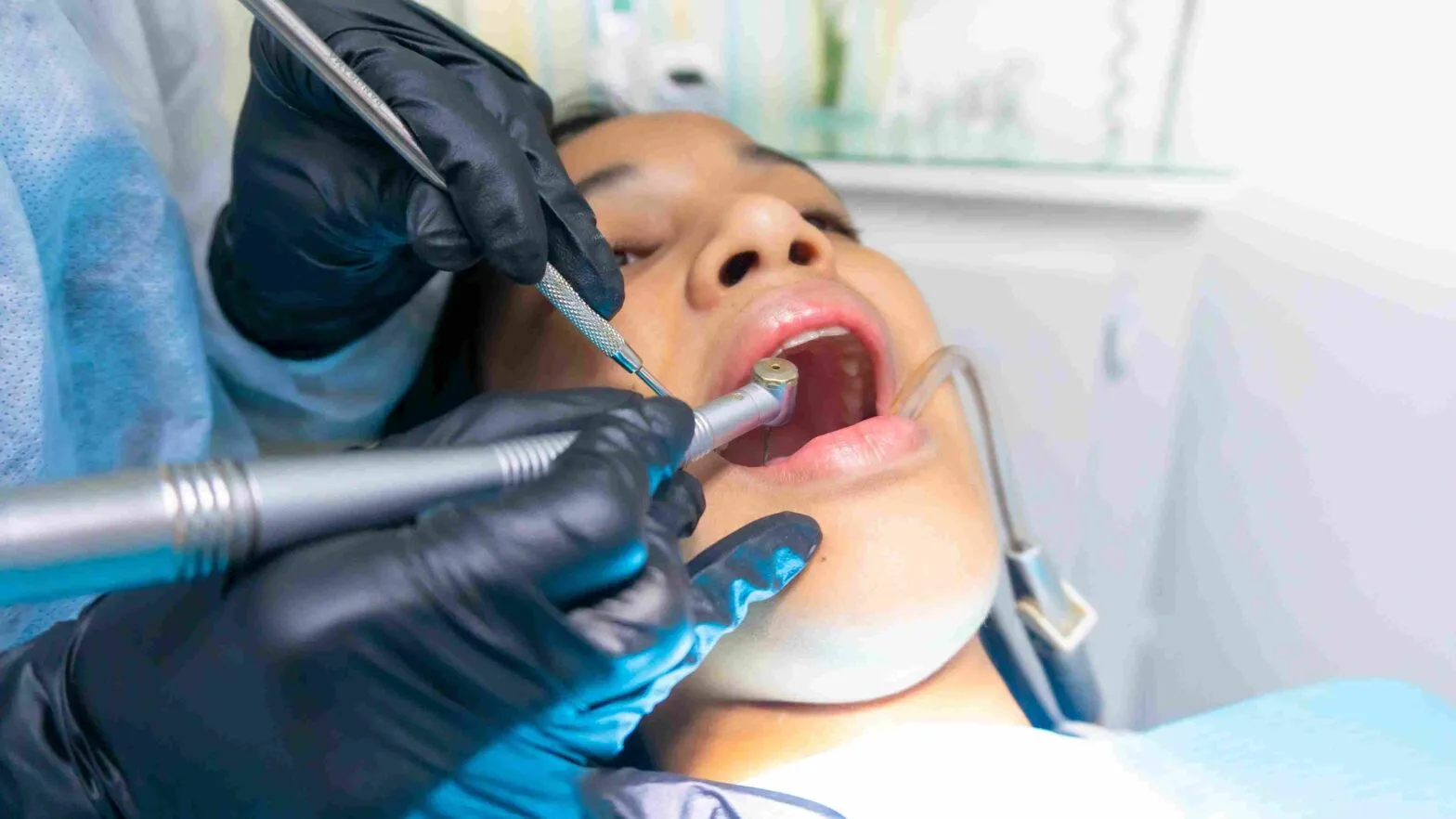Teeth Scaling And Polishing