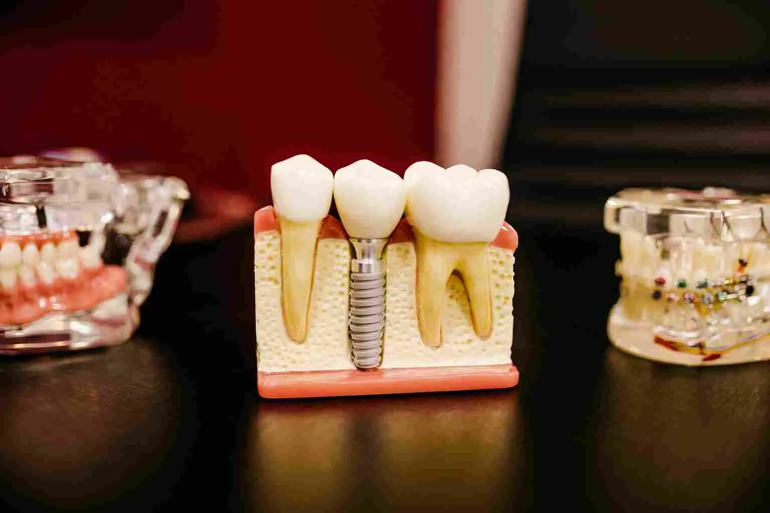 Do Dental Implants Hurt? | Best Dentists in Kuala Lumpur