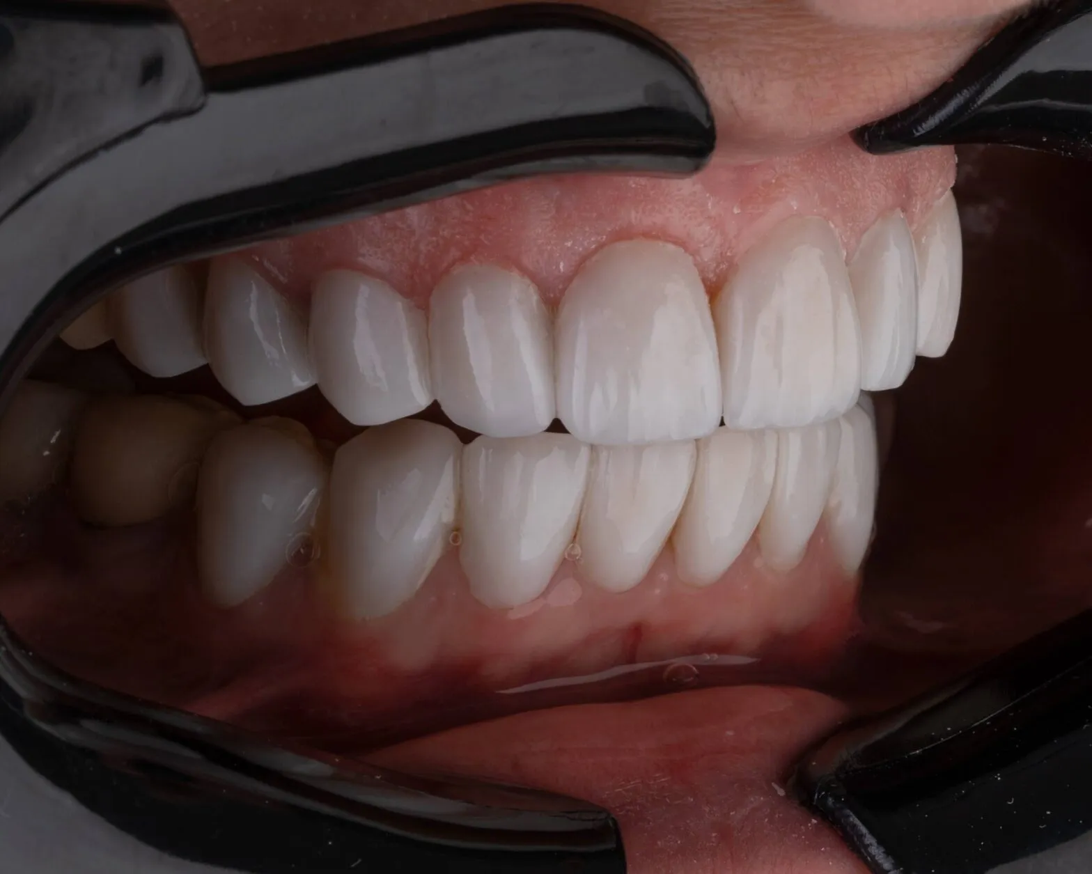 Teeth Whitening Price Malaysia