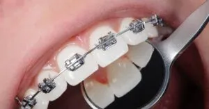 Braces Price Malaysia_ Comparing Different Types of Braces