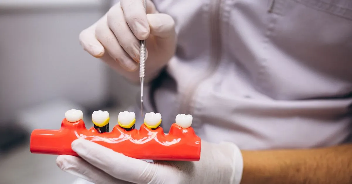 Can Teeth Whitening Gel Be Used on Veneers or Crowns