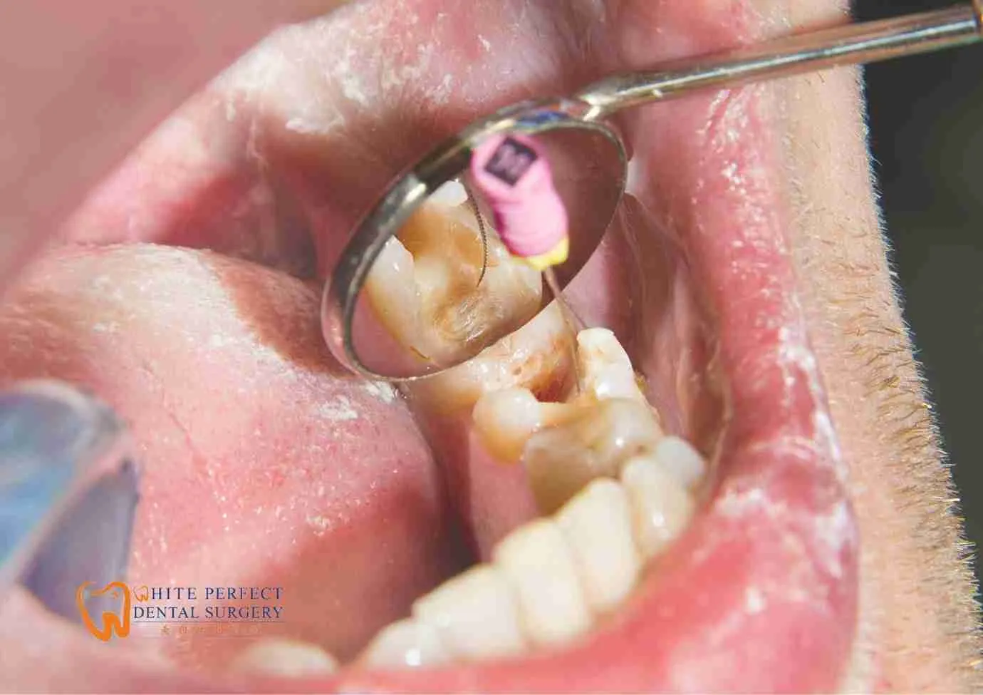 root canal treatment cost