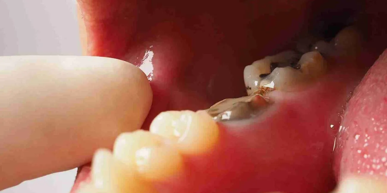 root canal treatment cost