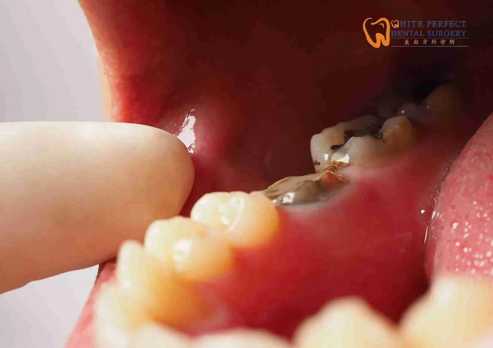 root canal treatment cost