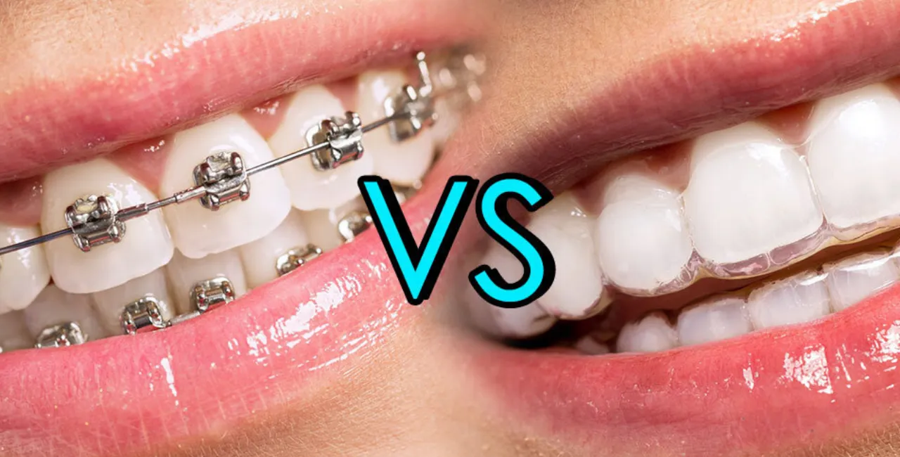 invisalign braces