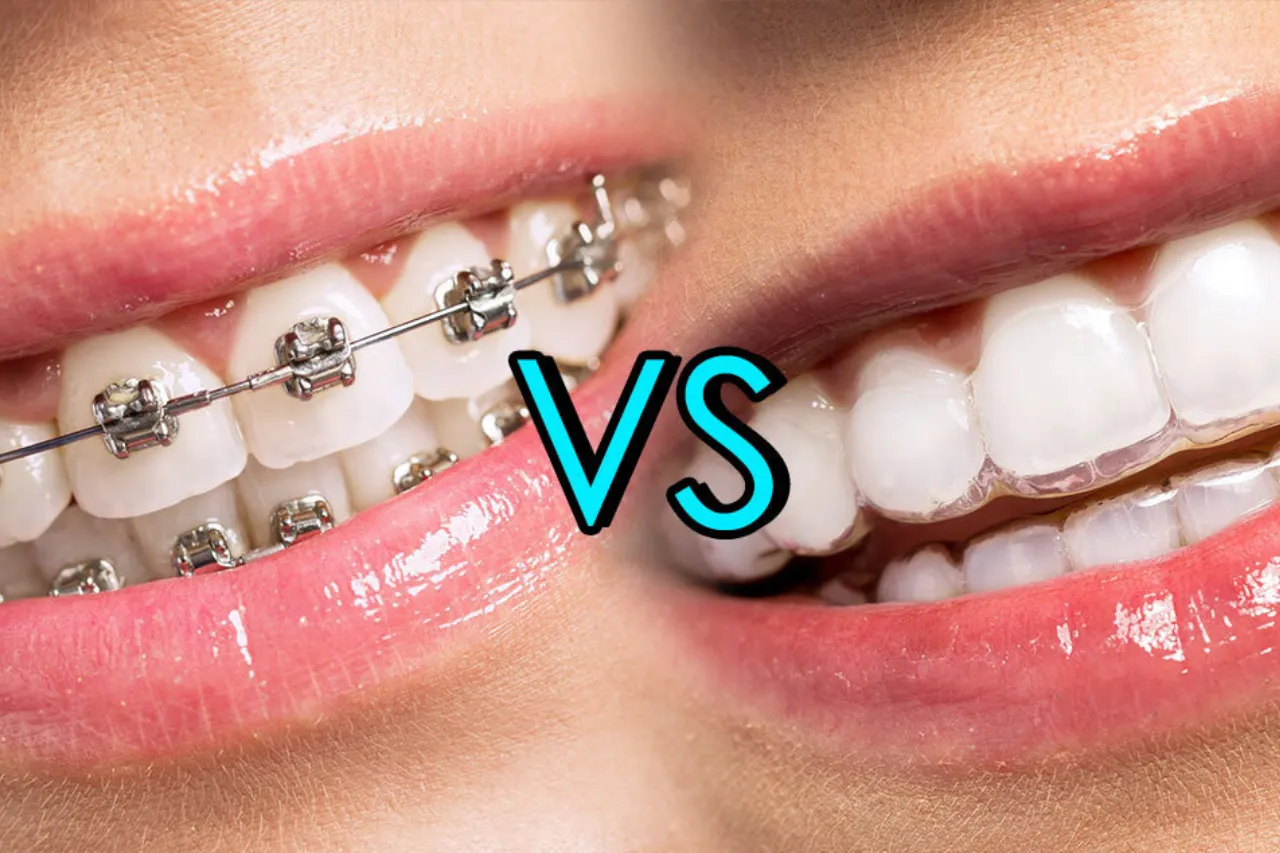 invisalign braces