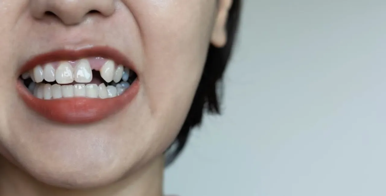 implant tooth cost in malaysia