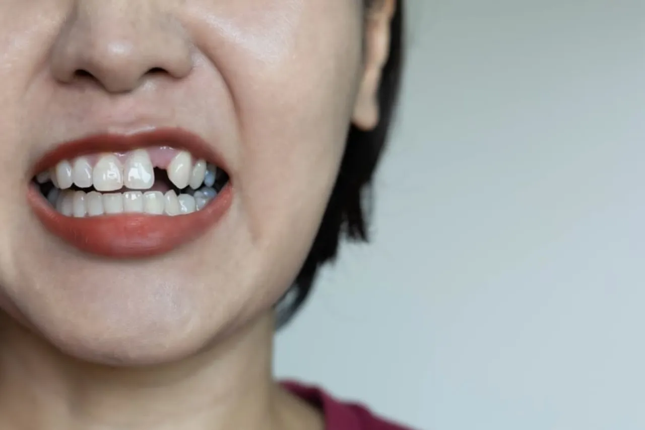 implant tooth cost in malaysia