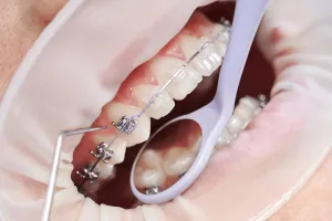 braces price