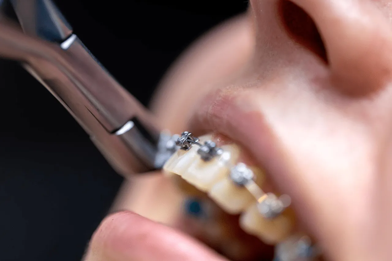 braces price