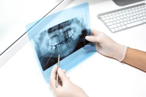 root canal treatment cost