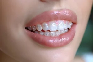 a girl with invisible braces