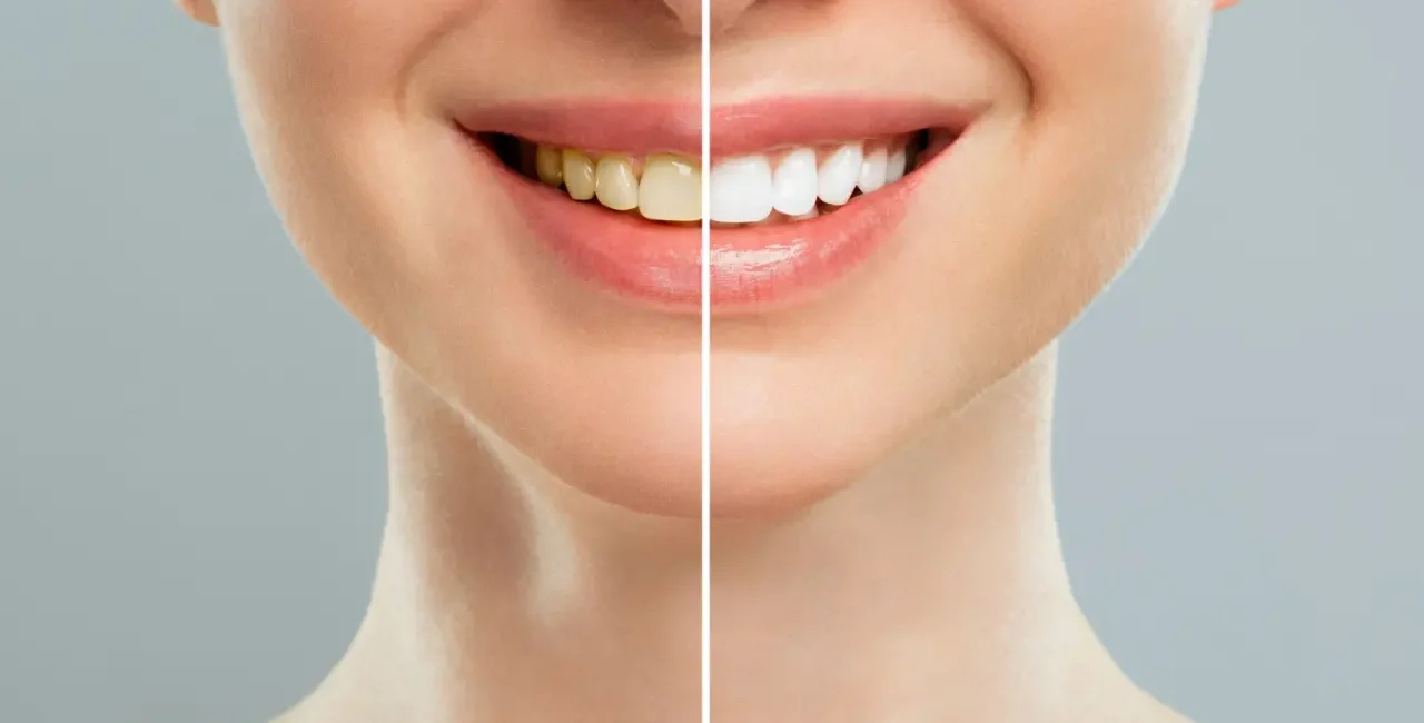 teeth whitening near me