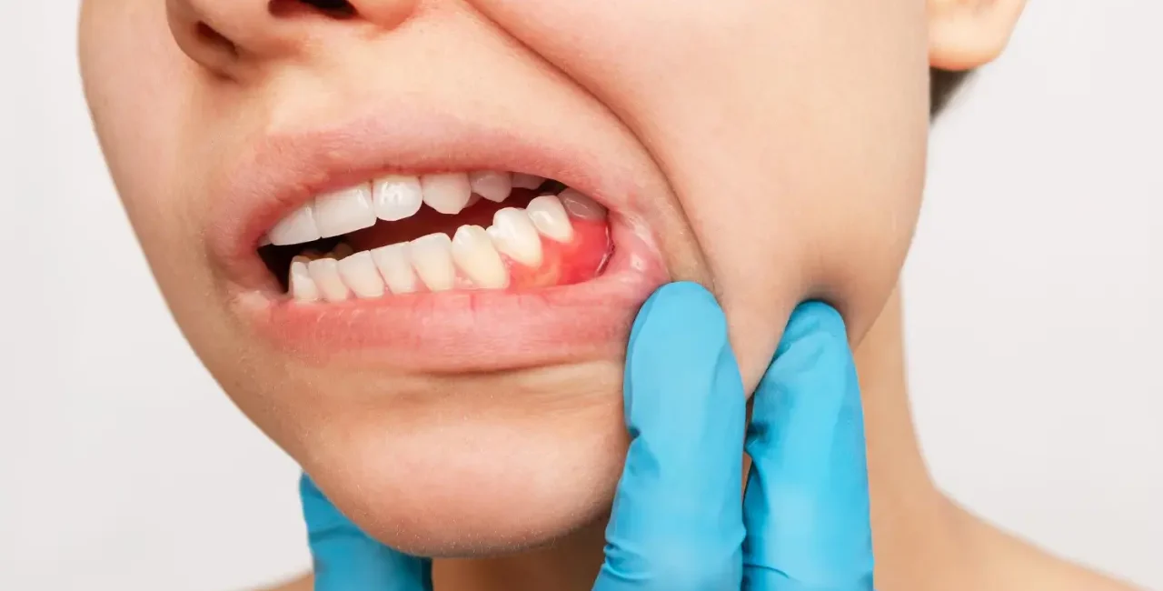 person having gum disease